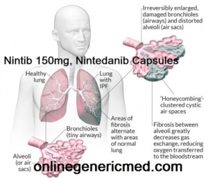 Nintib 150mg, Nintedanib Capsules