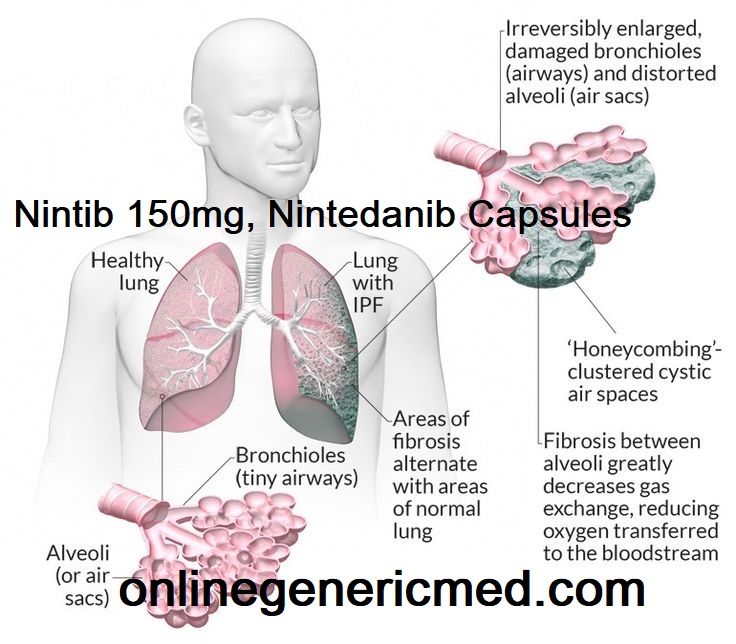Nintib 150mg, Nintedanib Capsules