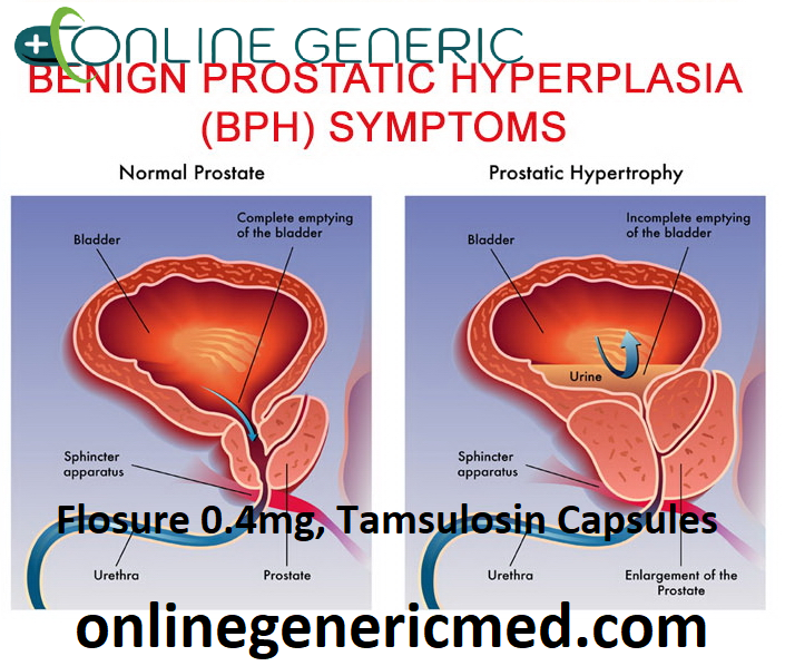 Flosure 0.4mg, Tamsulosin Capsules
