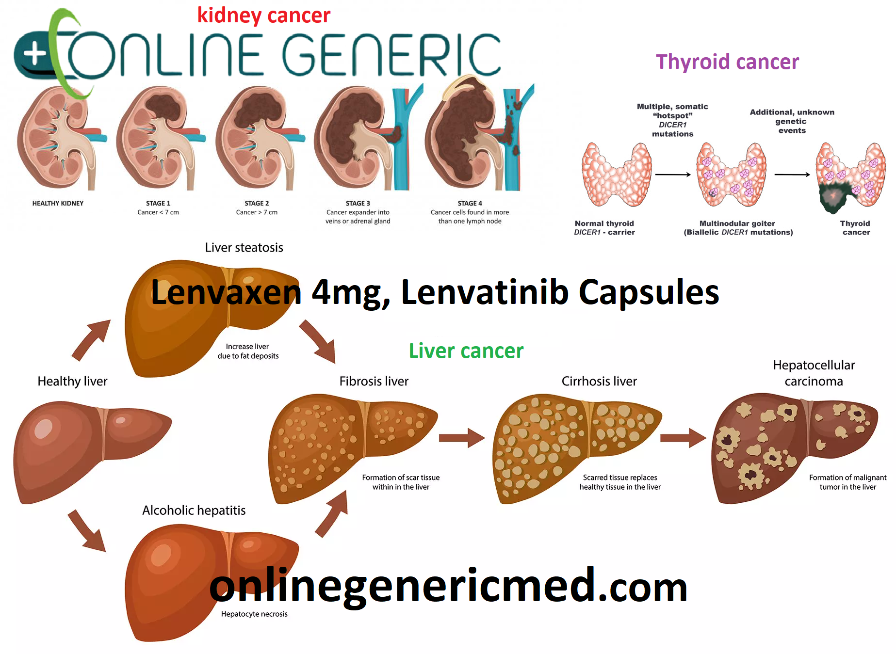 Lenvaxen 4mg, Lenvatinib Capsules