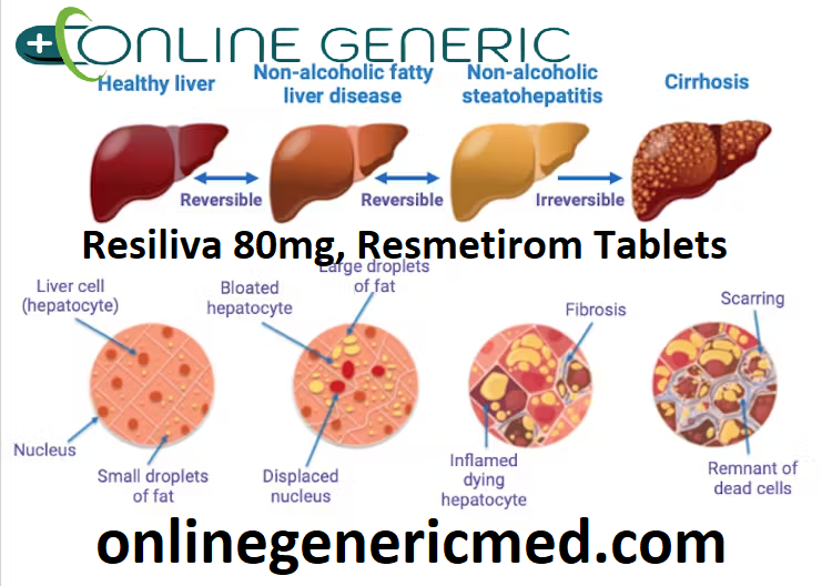 Resiliva 80mg, Resmetirom Tablets